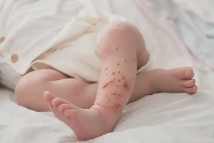 新生兒大腿經(jīng)常長濕疹能靠自己自愈嗎(圖4)