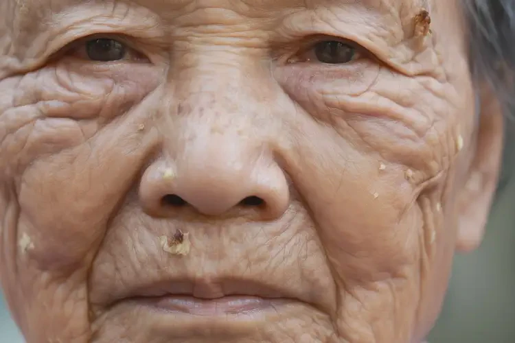 高齡老人大腿長(zhǎng)濕疹可不可以徹底自愈(圖4)