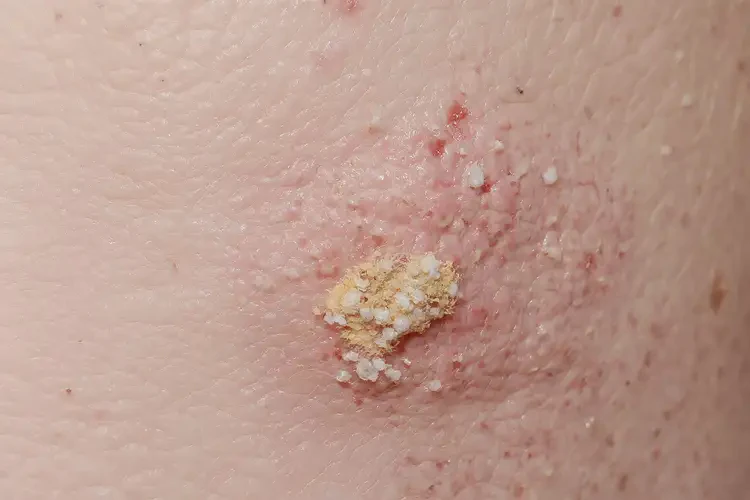 孩子小腿偶爾長濕疹不管它會自己痊愈嗎(圖3)