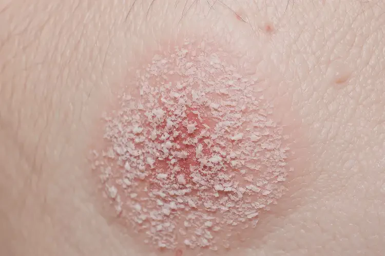 男人大腿上出濕疹不管它會自己好嗎(圖4)