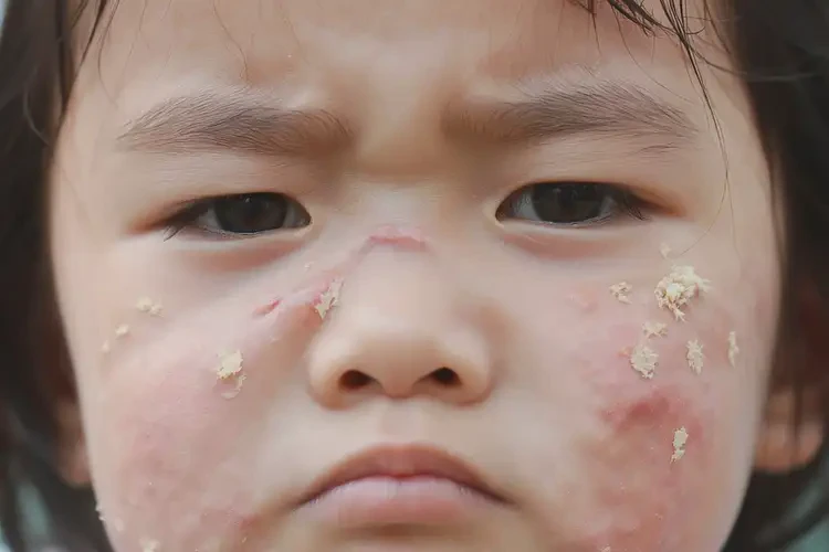 小學(xué)生面部經(jīng)常長(zhǎng)濕疹不管它會(huì)自己好嗎(圖4)