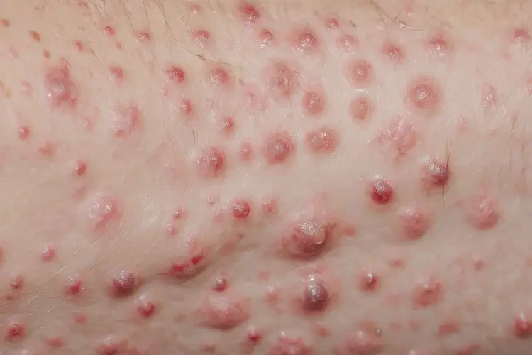 新生兒四肢偶爾起濕疹不管它會自己好嗎(圖3)