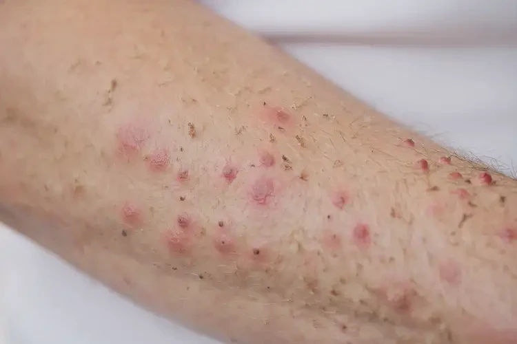 男人屁股出现湿疹能够彻底治愈吗(图4)