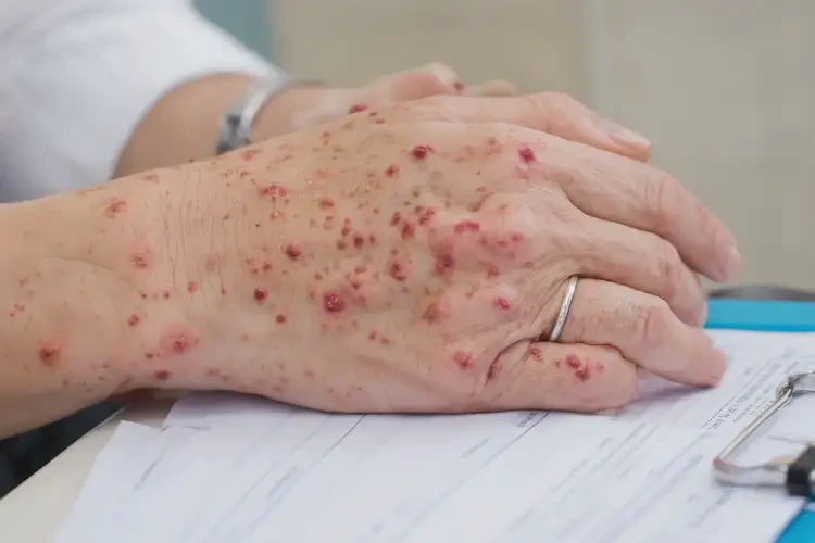 孕婦手上偶爾長(zhǎng)濕疹不管它會(huì)自己痊愈嗎(圖4)