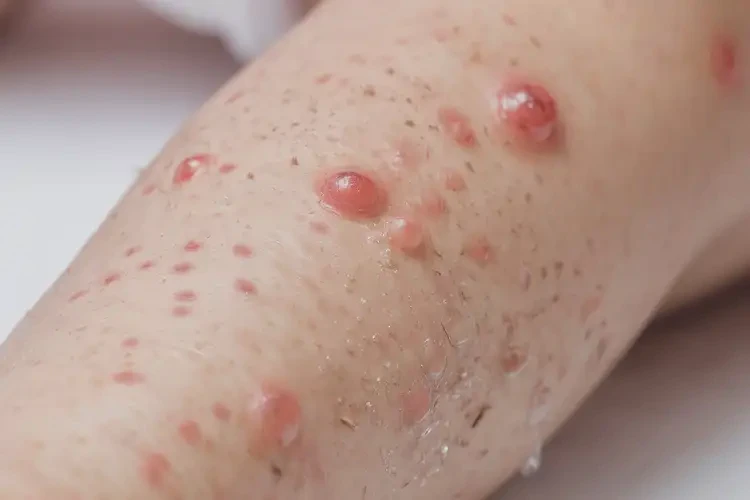 孩子小腿上经常长湿疹可以彻底自愈吗(图4)