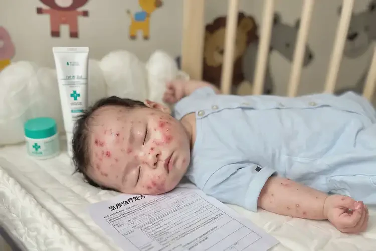 嬰兒全身經(jīng)常起濕疹可不可以徹底自愈(圖4)