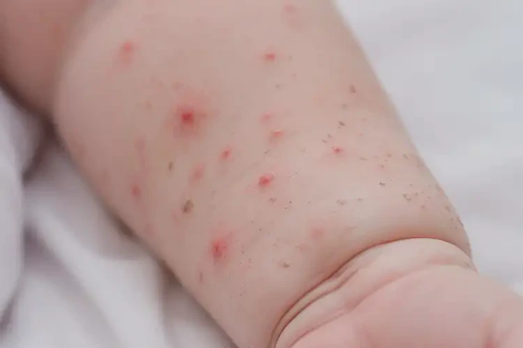 新生兒手臂上起濕疹不管它會自己自愈嗎(圖4)