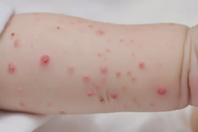 嬰兒手臂上長(zhǎng)濕疹可不可以徹底自愈(圖4)