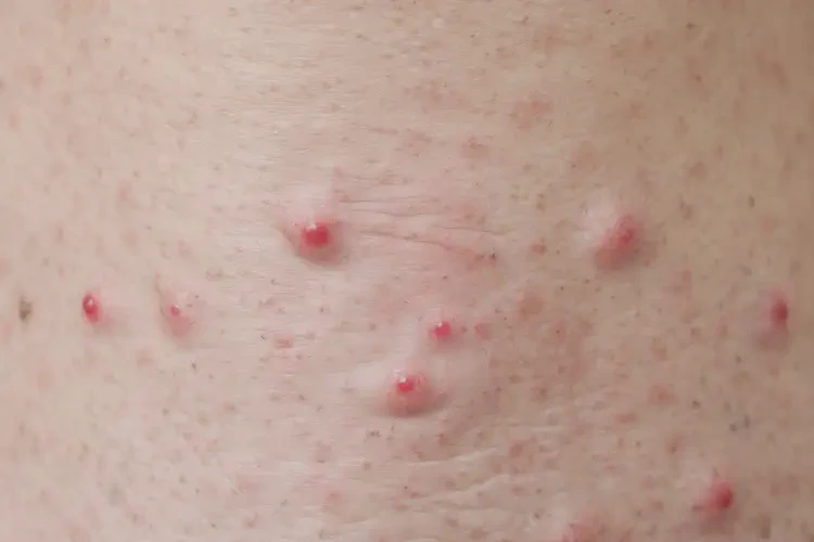 女性肛周容易長濕疹不管它會(huì)自己好嗎(圖4)