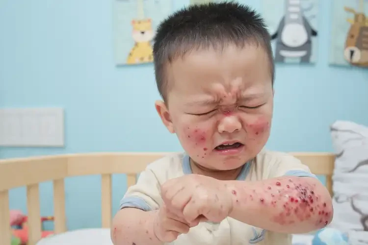 小孩身上偶爾起濕疹不管它會(huì)自己好嗎(圖3)