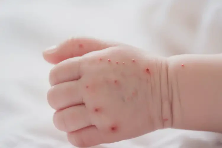 新生兒手上有濕疹可以徹底自愈嗎(圖4)