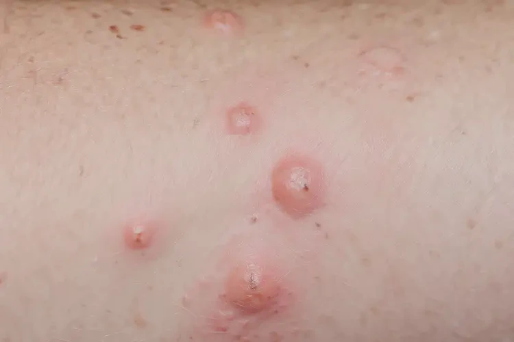 男生全身经常长湿疹可以彻底自愈吗(图4)