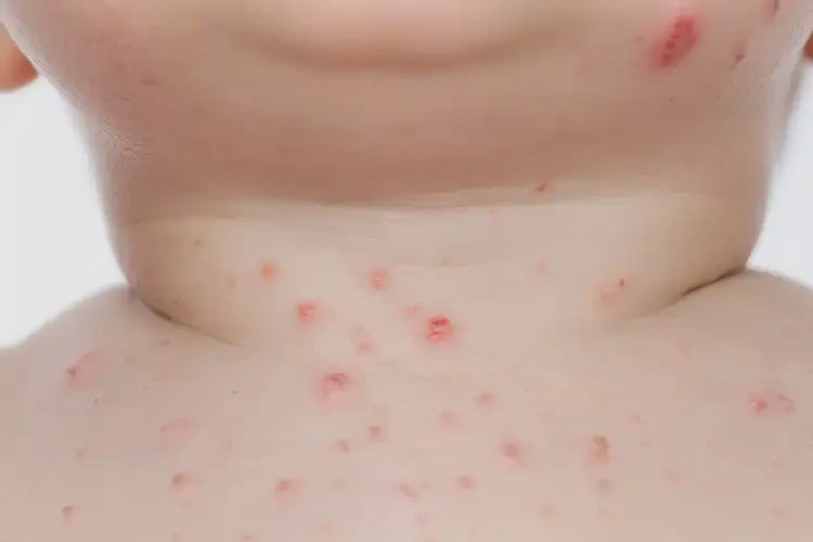 幼兒脖子上容易長(zhǎng)濕疹能徹底自愈嗎(圖4)