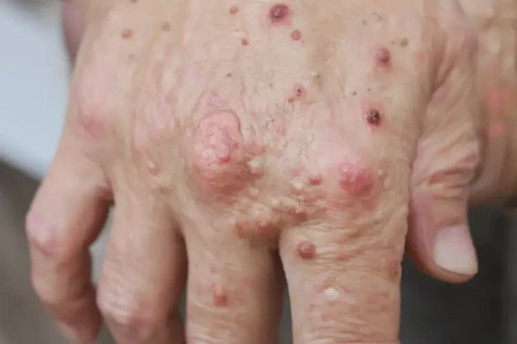 女性手上經(jīng)常長濕疹可不可以徹底自愈(圖4)