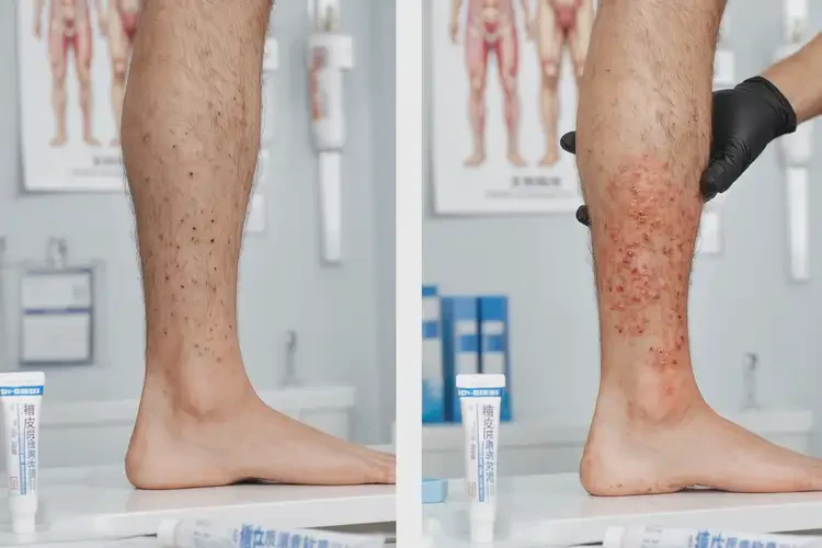 男人小腿上經(jīng)常長濕疹可不可以徹底自愈(圖3)