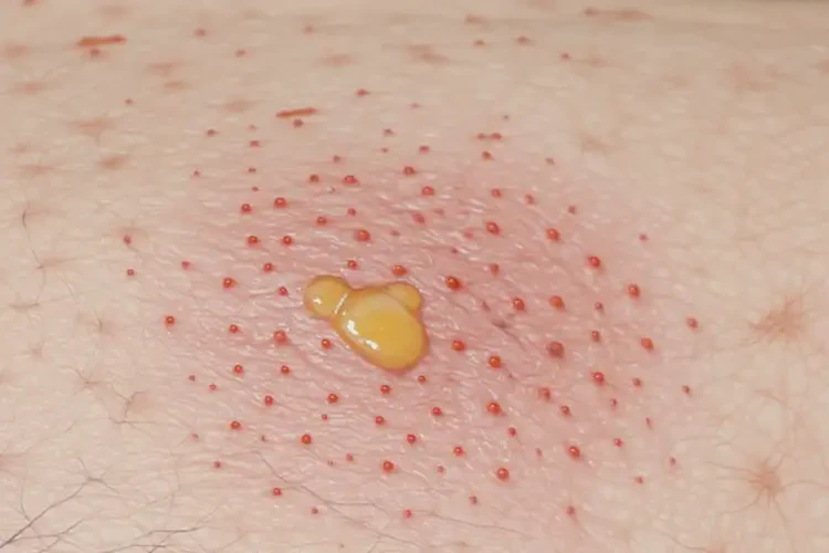 大學(xué)生肚子上有濕疹不管它會自己自愈嗎(圖4)