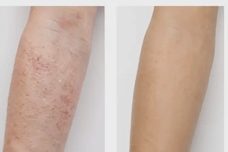 老年人屁股上偶爾長濕疹不管它會自己自愈嗎(圖2)