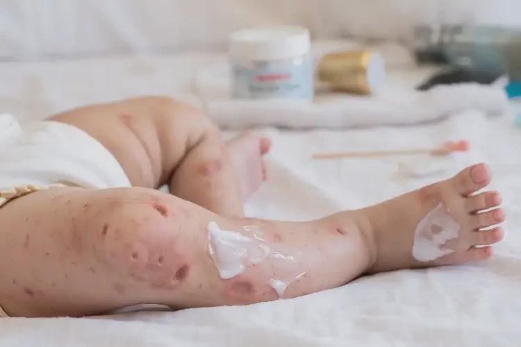 寶寶小腿出現(xiàn)濕疹能徹底自愈嗎(圖3)