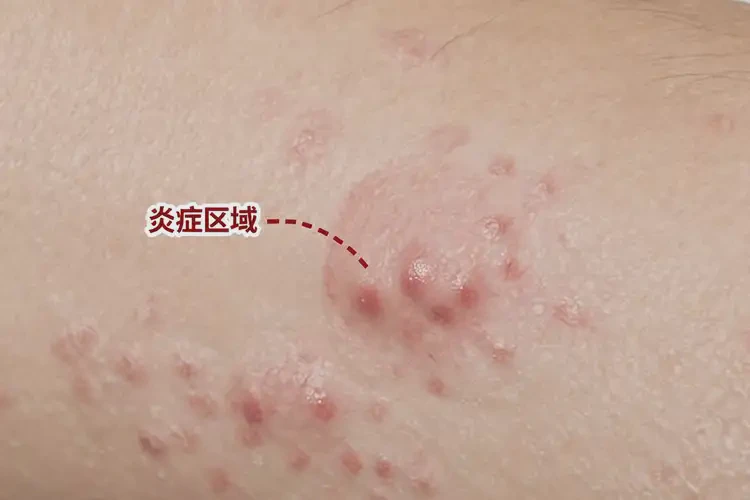 男人四肢出現(xiàn)濕疹不管它會自己痊愈嗎(圖4)