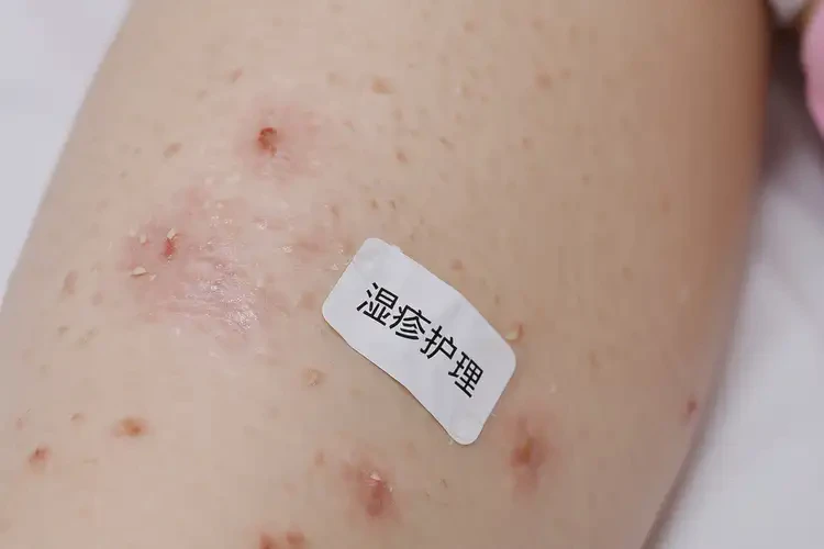 小兒大腿偶爾長濕疹可不可以徹底自愈(圖4)