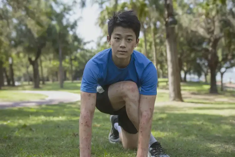 青少年四肢經(jīng)常起濕疹不管它會自己好嗎(圖1)