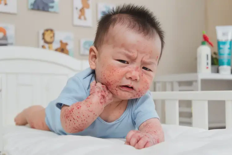 寶寶全身經(jīng)常長濕疹不管它會自己自愈嗎(圖4)