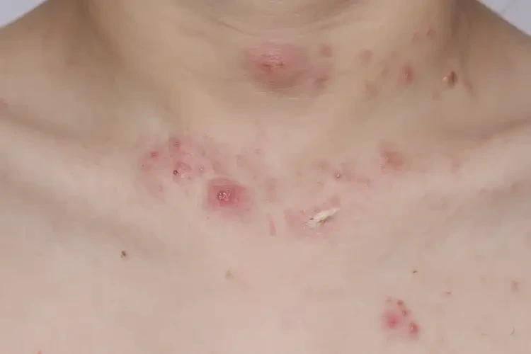 兒童脖子偶爾長濕疹不管它會自己自愈嗎(圖3)