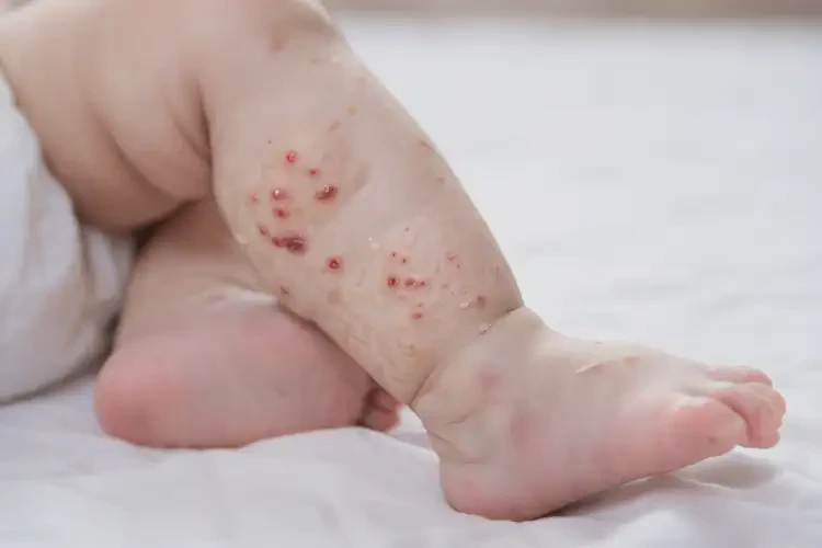 嬰兒小腿上起濕疹可以徹底自愈嗎(圖3)