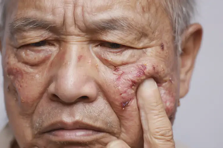 老人面部出濕疹可不可以徹底自愈(圖4)
