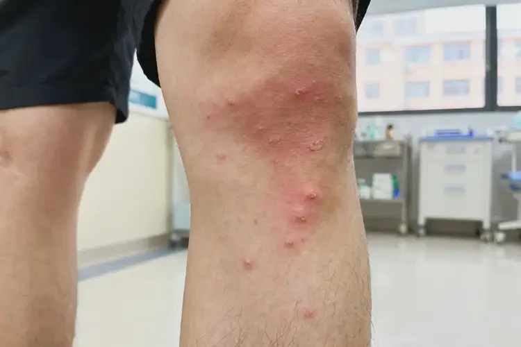 男生小腿上偶爾長濕疹不管它會(huì)自己好嗎(圖2)