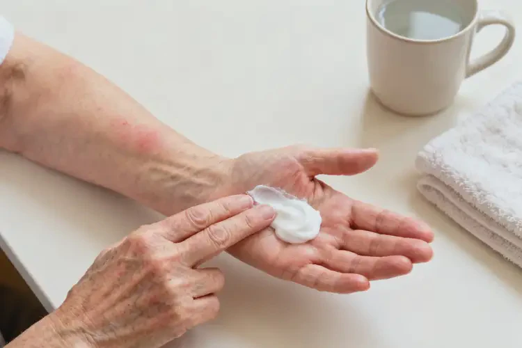 老人手上容易長濕疹能靠自己自愈嗎(圖4)