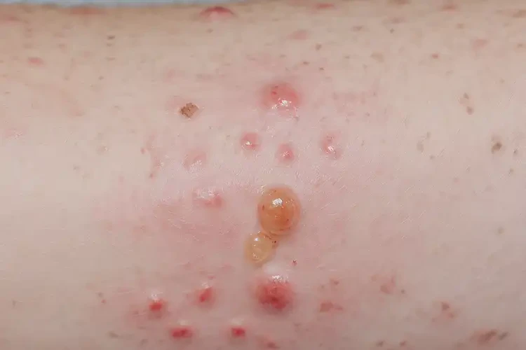 高齡老人大腿長(zhǎng)濕疹可不可以徹底自愈(圖3)