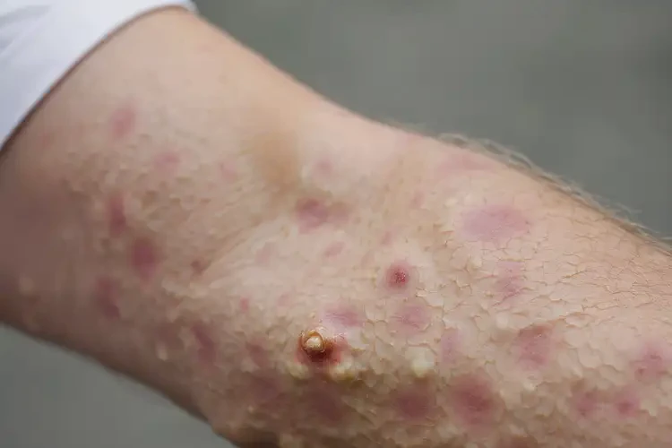 老年人手臂經(jīng)常長(zhǎng)濕疹可不可以徹底自愈(圖4)