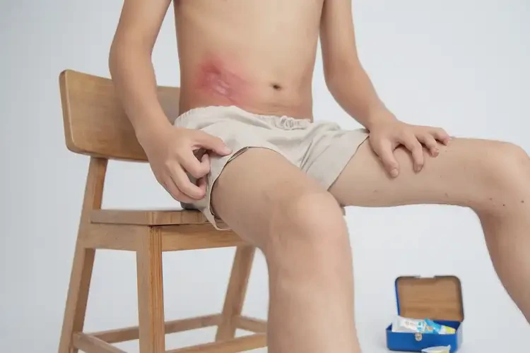 青少年屁股出現(xiàn)濕疹可不可以徹底自愈(圖1)