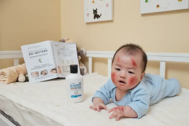 寶寶四肢容易長濕疹不管它會自己自愈嗎(圖2)