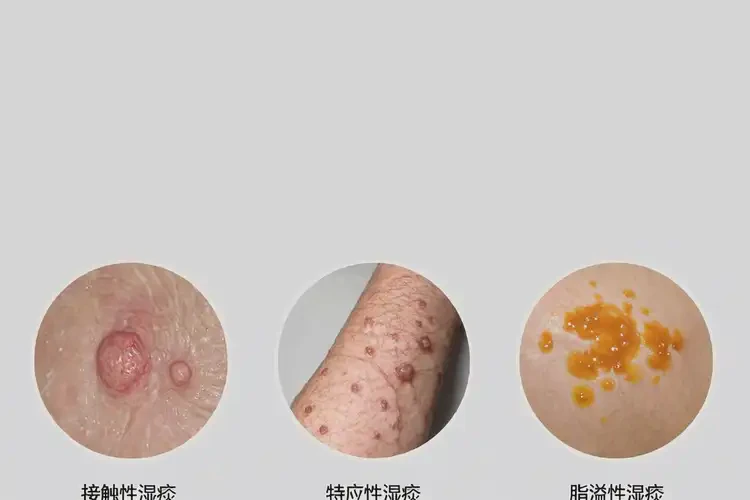 男性手上偶爾起濕疹可以徹底自愈嗎(圖3)