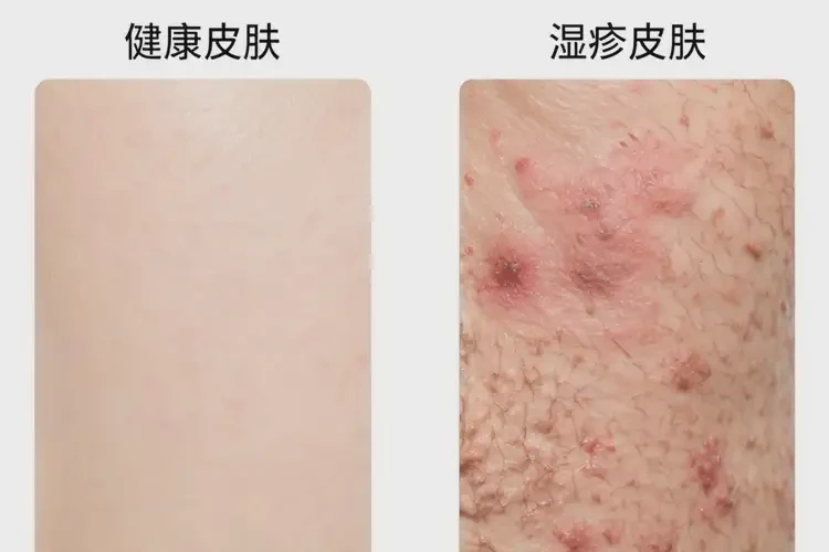 女生大腿上容易長濕疹不管它會自己痊愈嗎(圖3)