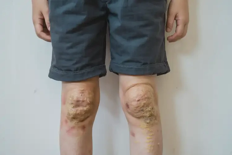 青少年四肢偶爾起濕疹不管它會自己自愈嗎(圖3)