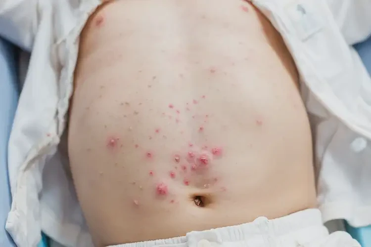 嬰幼兒肚子上經(jīng)常起濕疹不管它會自己好嗎(圖4)