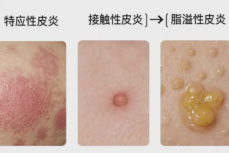 女性臉上偶爾起濕疹能靠自己自愈嗎(圖3)