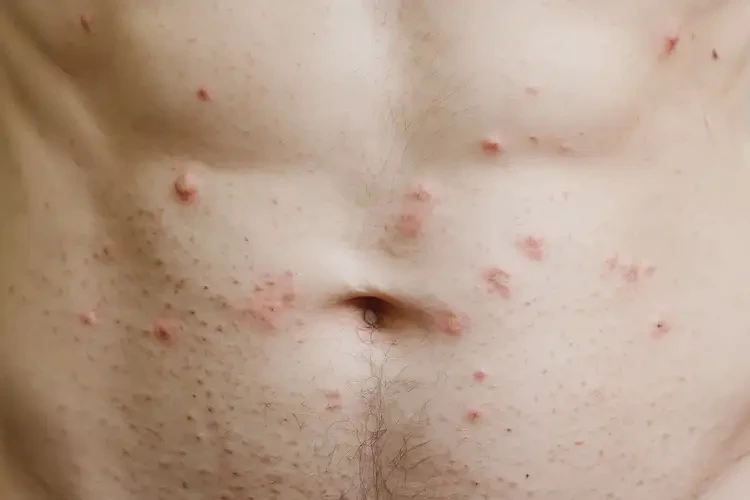 男性肚子上經(jīng)常起濕疹不管它會自己好嗎(圖4)