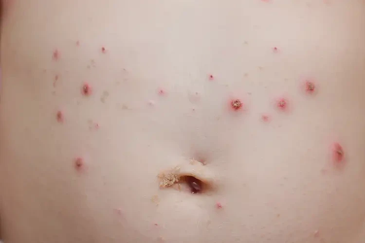 小兒肚子偶爾起濕疹能徹底自愈嗎(圖4)