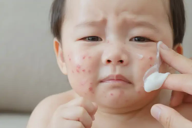 婴儿面部容易起湿疹不管它会自己痊愈吗(图3)