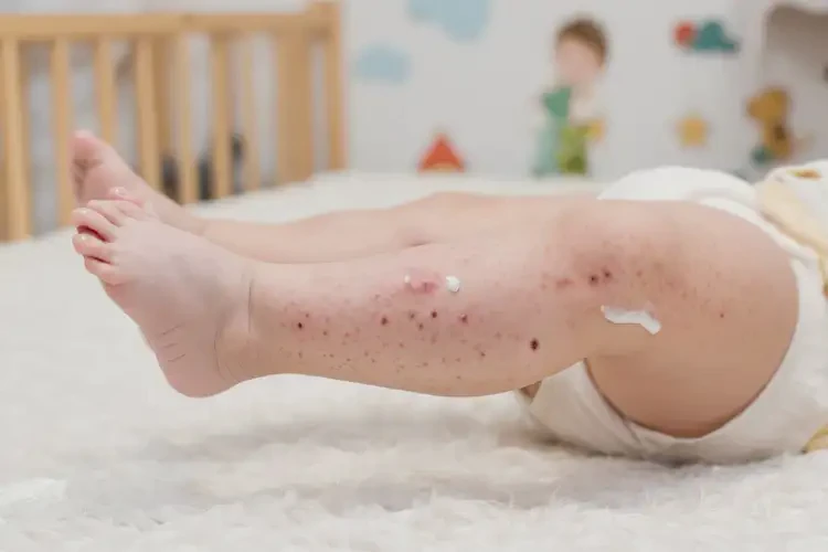 嬰幼兒大腿長濕疹可以徹底自愈嗎(圖4)