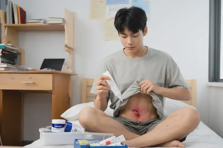 大學(xué)生肚子起濕疹能不能徹底自愈(圖2)