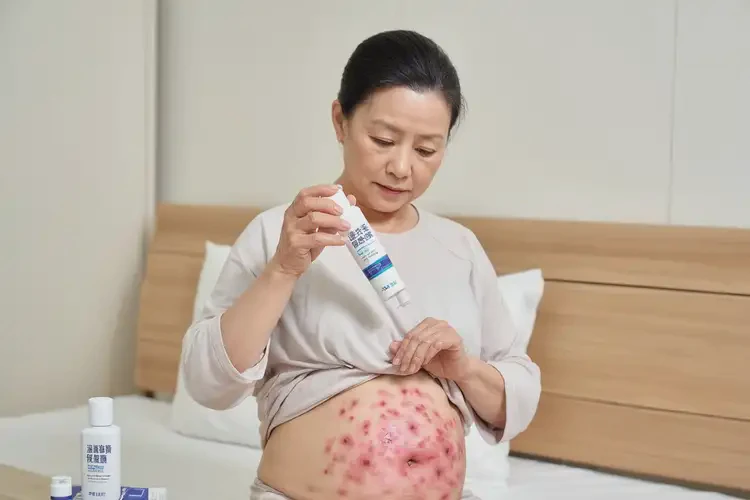 女人肚子上容易起濕疹不管它會自己好嗎(圖3)