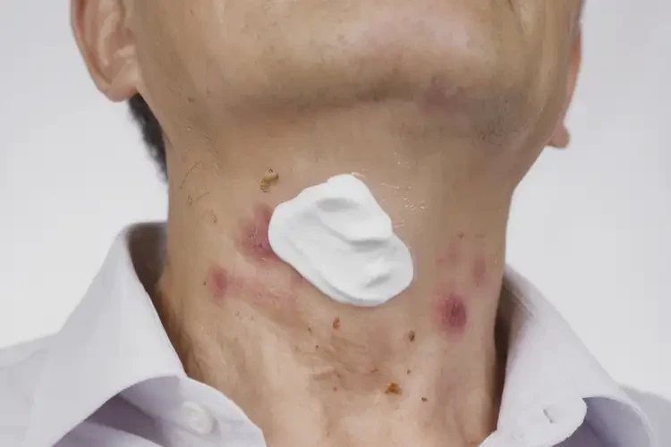 男人脖子出濕疹不管它會自己痊愈嗎(圖2)