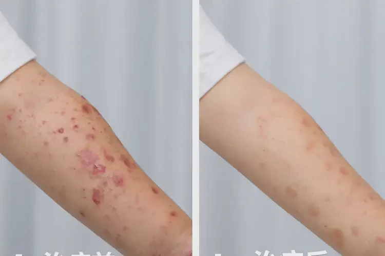 小兒肚子出濕疹不管它會自己好嗎(圖1)