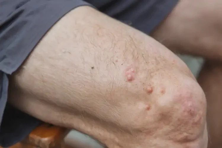 老人大腿上偶爾長濕疹不管它會自己好嗎(圖4)