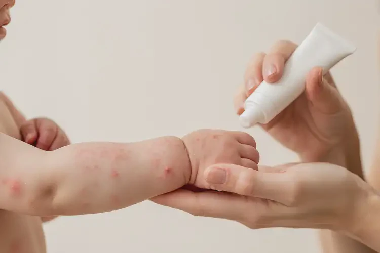 婴儿手上出现湿疹能彻底自愈吗(图3)